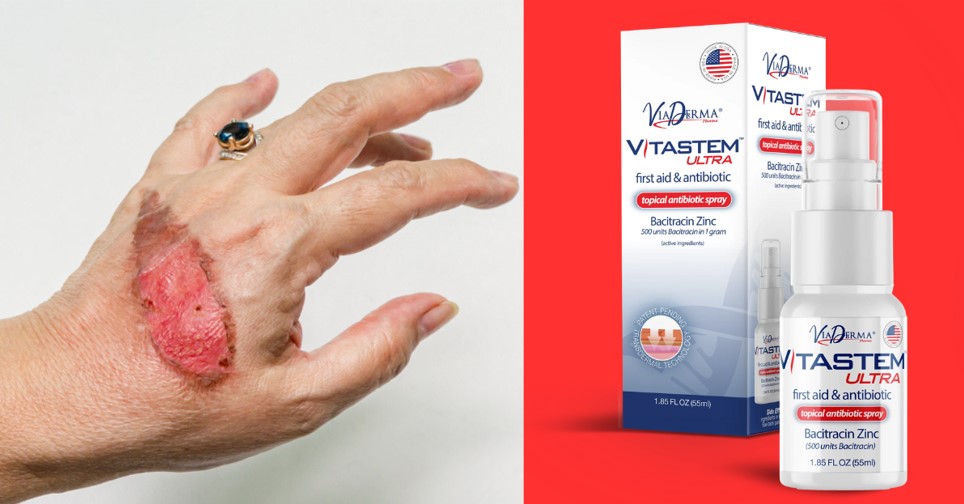 Vitastem - Treating First to Third-Degree Burns 10x Better Than the Rest